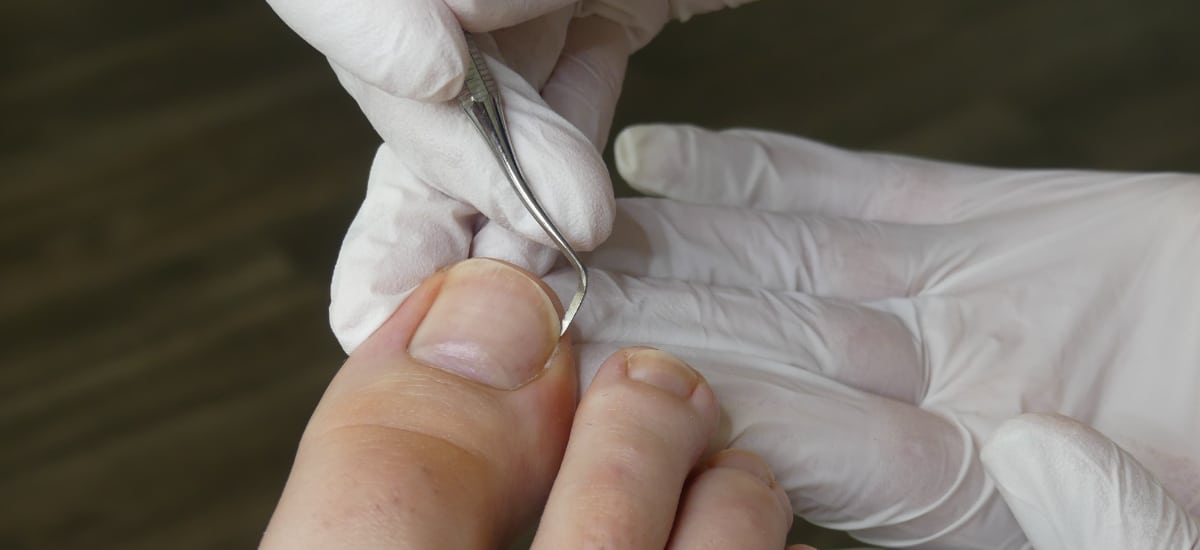 Doctor digging out ingrown toenail